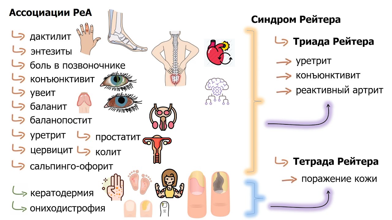 Клиническая картина синдром рейтера