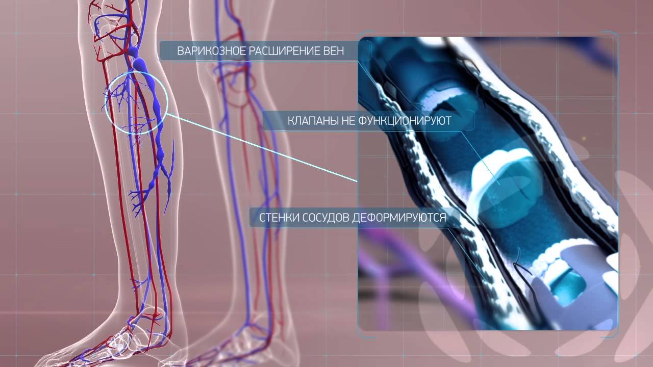 Клапан на вене ноги. Варикозное расширение вен нижних. Венозный клапан нижних конечностей.