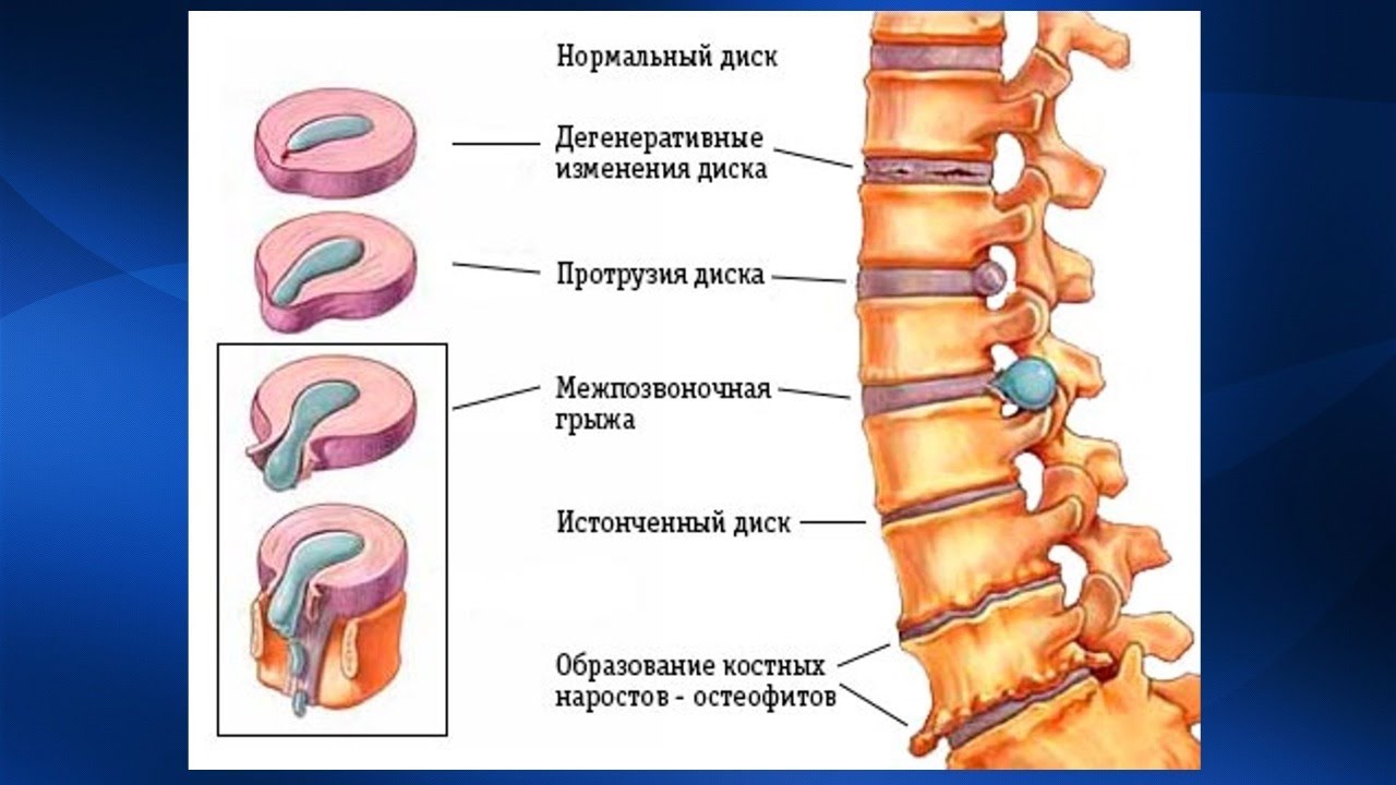 Грыжа межпозвонковых дисков презентация