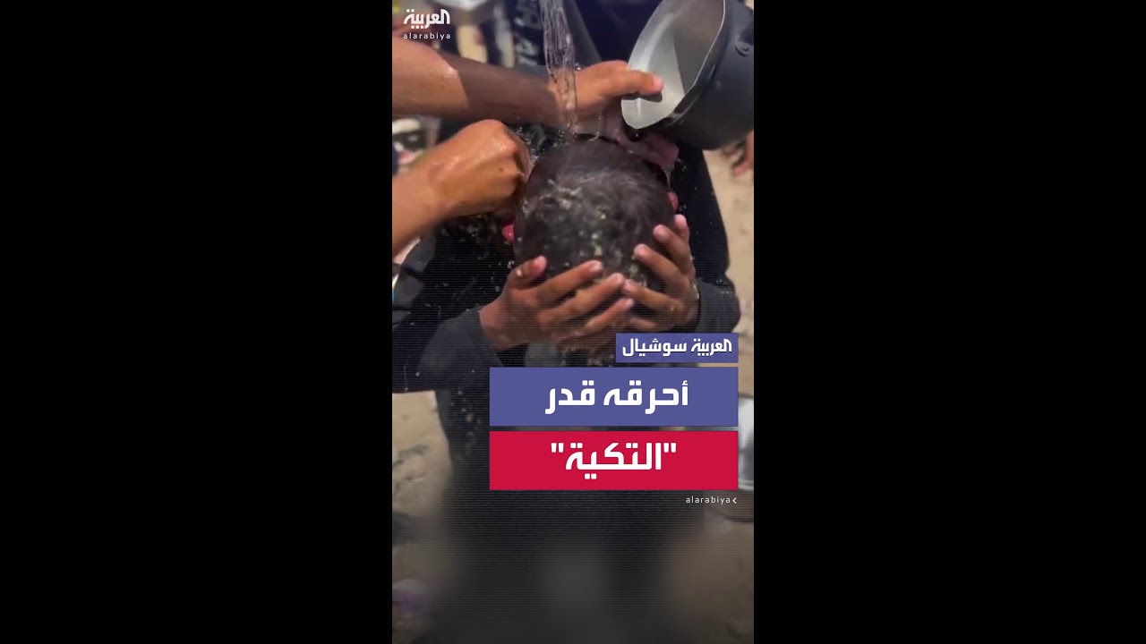 طفل فلسطيني يصرخ من الألم بعدما انكسب عليه قدر "تكية" ساخن