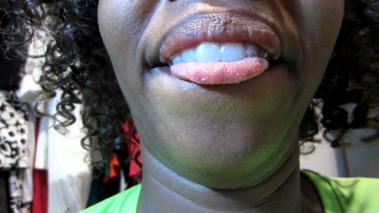 i-have-a-zit-on-my-tongue-i-m-a-freak-glozell-youtube