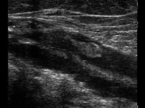 Popliteal Vein