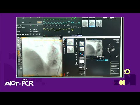 Image-guided PCI of distal left main disease - AICT-AsiaPCR 2024