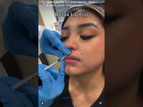 Masseter Botox & Lip Flip Achieve facial harmony 🤩 #botox #jawline #lipflip
