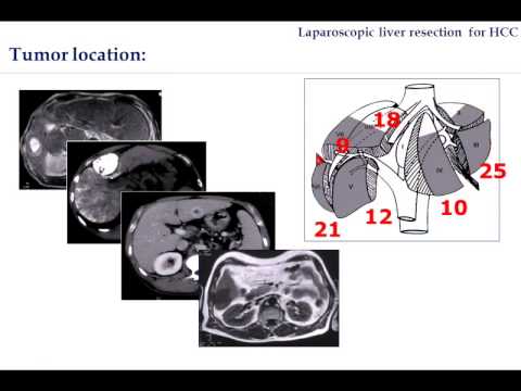 Laparoscopic Liver Resection for Hepatocellular Carcinoma LLR 4 HCC 