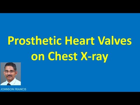 Upload mp3 to YouTube and audio cutter for Prosthetic Heart Valves on Chest X ray download from Youtube