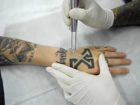 Апарат за ласерско отстранување тетоважи
