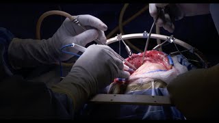 Brain Surgery (Craniotomy) | Inside the OR