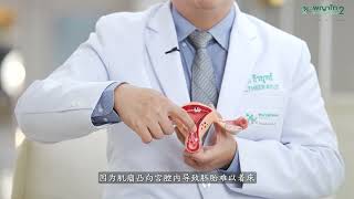 How does a uterine fibroid affect IVF 子宫肌瘤会不会对做试管婴儿有影响