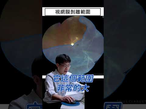 如果突然出現飛蚊症或局部視野變暗的現象，很有可能是視網膜剝離的警訊⚠️這時請立即就醫以免延誤治療導致失明唷！#蕭家杰醫師 #高雄眼科醫師 #屏東眼科醫師 #大學眼科 #眼科手術 #視網膜剝離