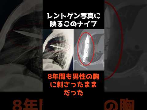 8年間胸にナイフが刺さった男性の驚きの真実と事件解説 サムネイル