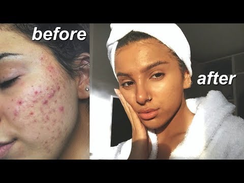 MY SKIN CARE ROUTINE/PRODUCTS THAT SAVED MY SKIN! (acne prone skin)