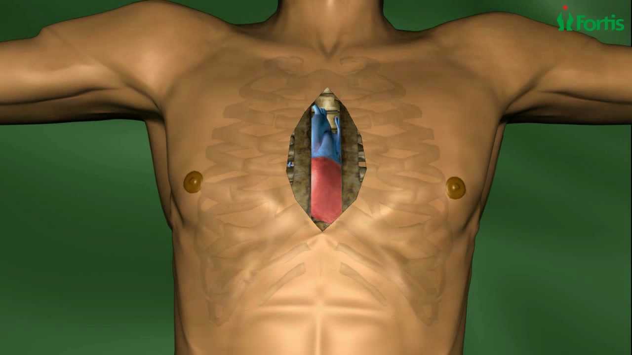 Endoscopic Mitral Valve Repair Minimally Invasive Cardiac Surgery Fortis Healthcare Limited