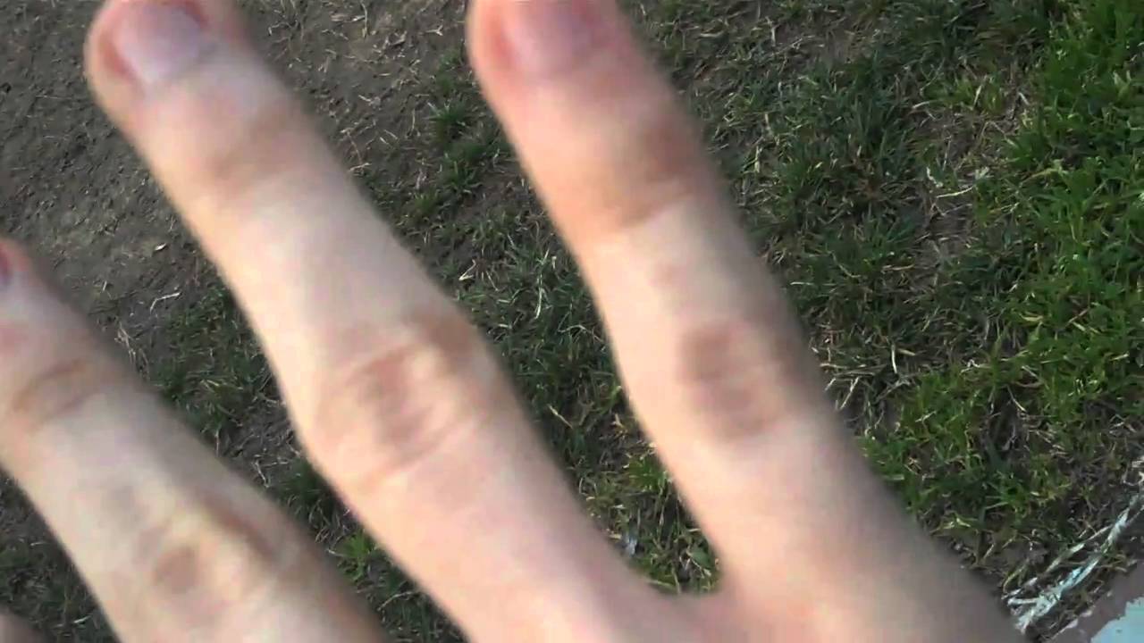 Dislocated Pinky [nearly Broken] Youtube