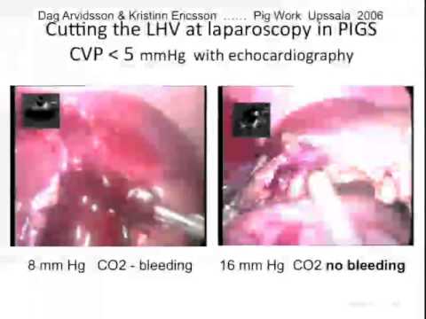 Laparoscopic Liver resection: technical tips for starters 
