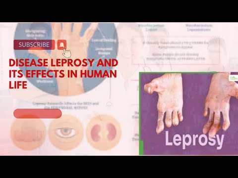 Essay on disease Leprosy in English/Causes of Leprosy/How to Leprosy is Transmitted/Effects Leprosy