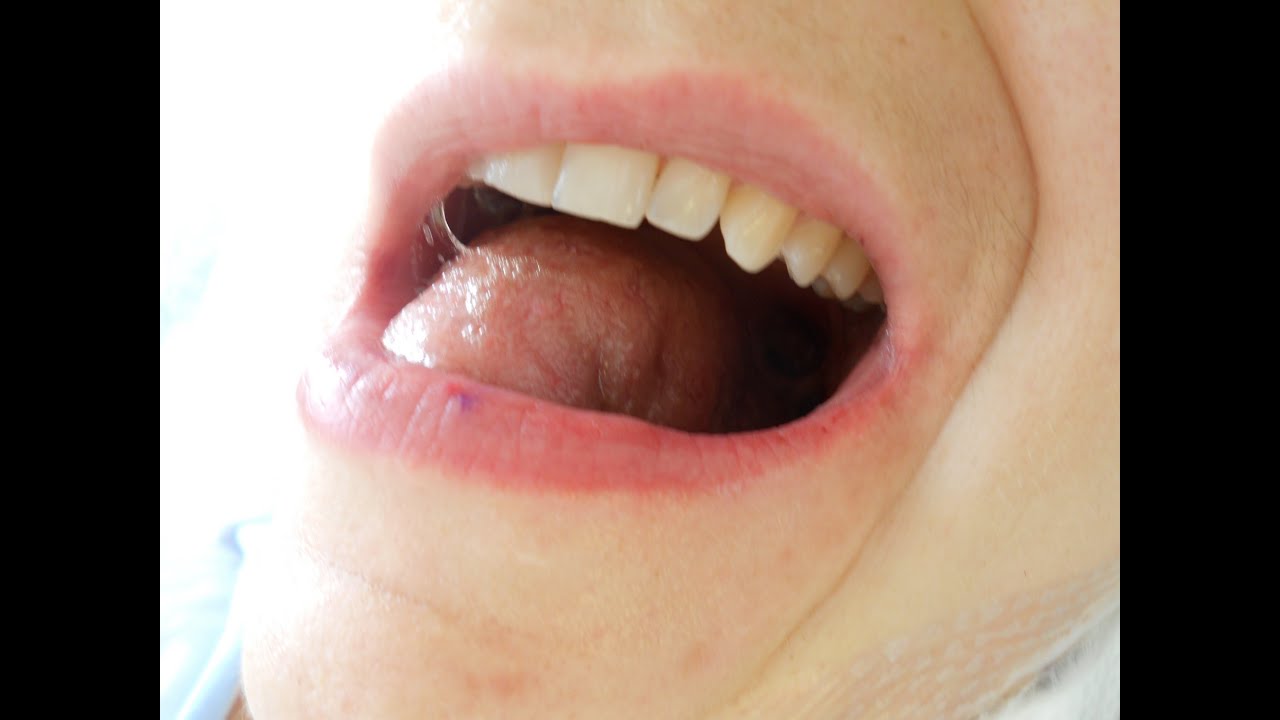 Tongue Cancer In Young People What To Expect Post Operation Speaking 