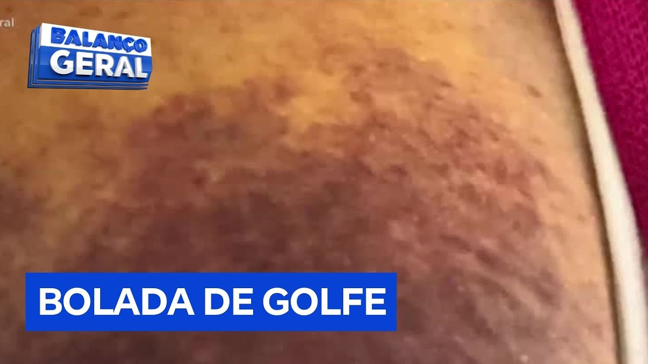 Mulher sofre derrame e é hospitalizada após ser atingida por bola de golfe na Califórnia EUA