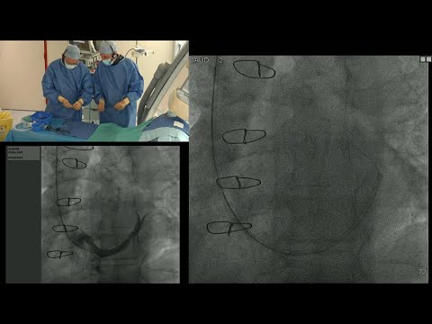 How should I treat patient with refractory angina using the Reducer Device? – Webinar