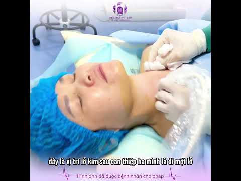 Sau 1 buổi đốt sóng cao tần khối bướu giáp to 30ML thay đổi như thế nào?