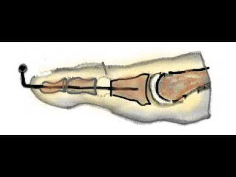 Hammer Toe - Diagnosis, and Treatment