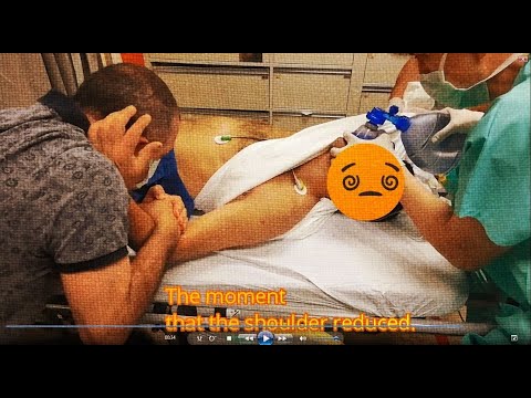 Shoulder Dislocation, Speedy, and Successful Reduction.