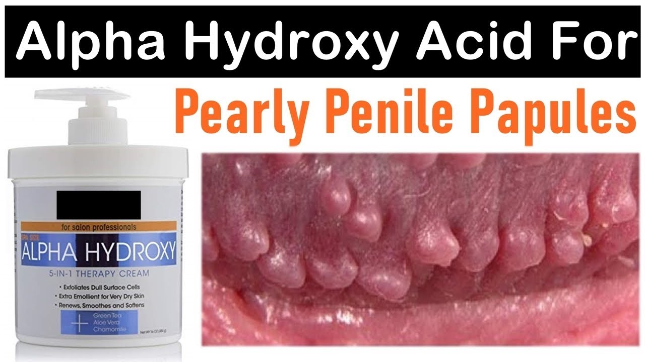 Penile papules treatment cream