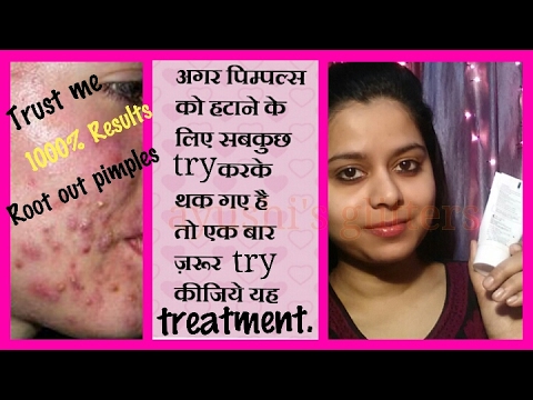 पिम्पल्स हटाने के लिए बेस्ट क्रीम और फेस वॉश | BENZOYL PEROXIDE acne treatment | 100% results