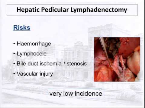 Role of hepatic pedicular lymphadenectomy during resection for colorectal liver metastasis 