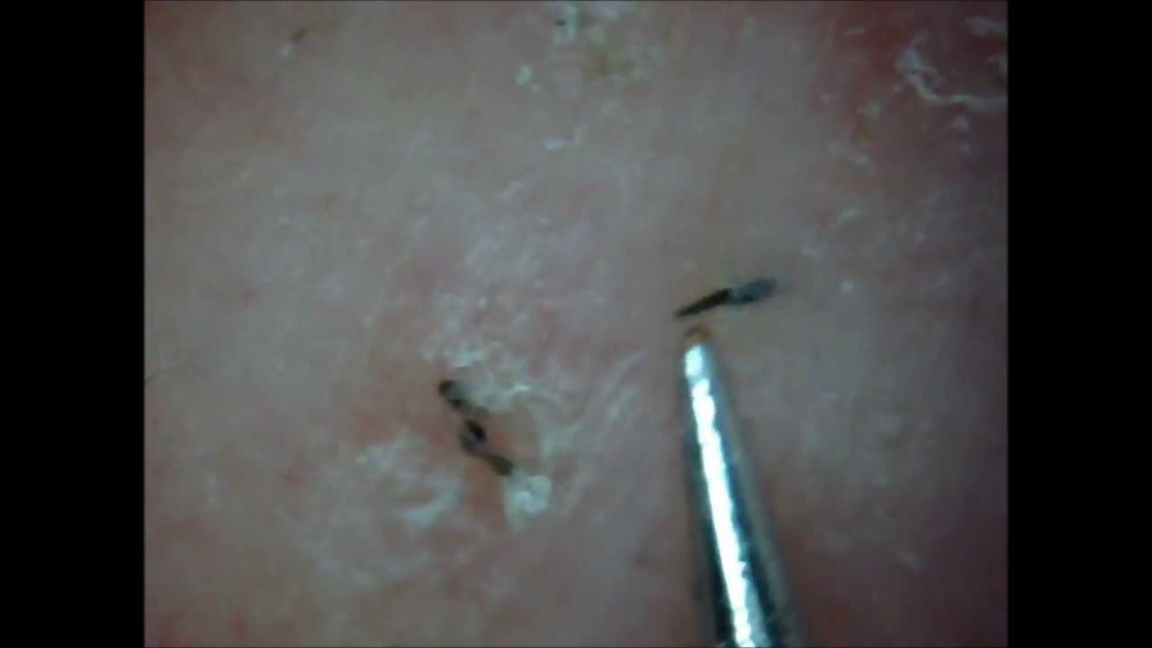 Pluck Ingrown Hair