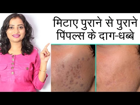 मिटाए पुराने से पुराने पिंपल्स के दाग-धब्बे | Home Remedies to Remove Pimple (Acne) Marks | Hindi