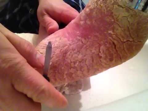 Skin Parasites - body, contagious, causes, What Are Skin ...