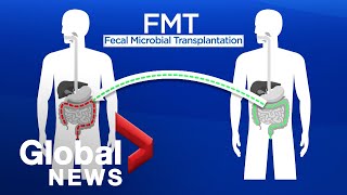 Fecal microbial transplant: What is it and how it can it be life-saving
