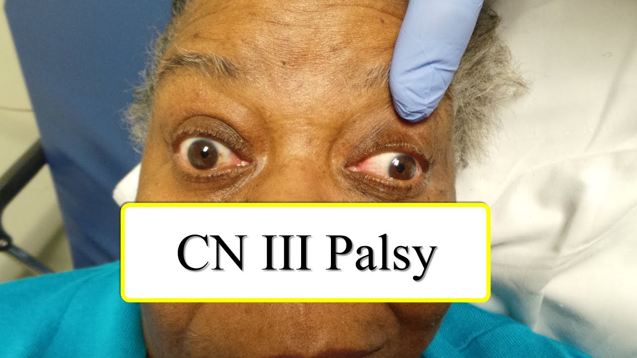 CN III Palsy - YouTube