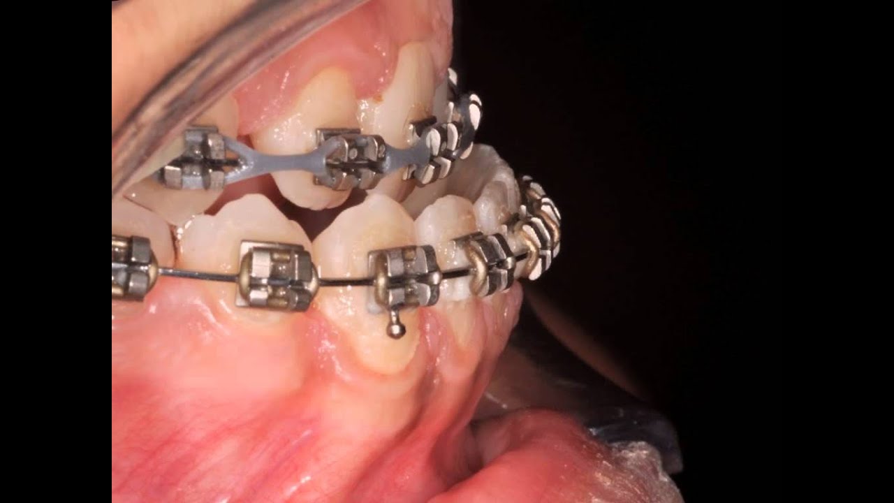 Class Iii Orthodontic Surgical Treatments Youtube 0172