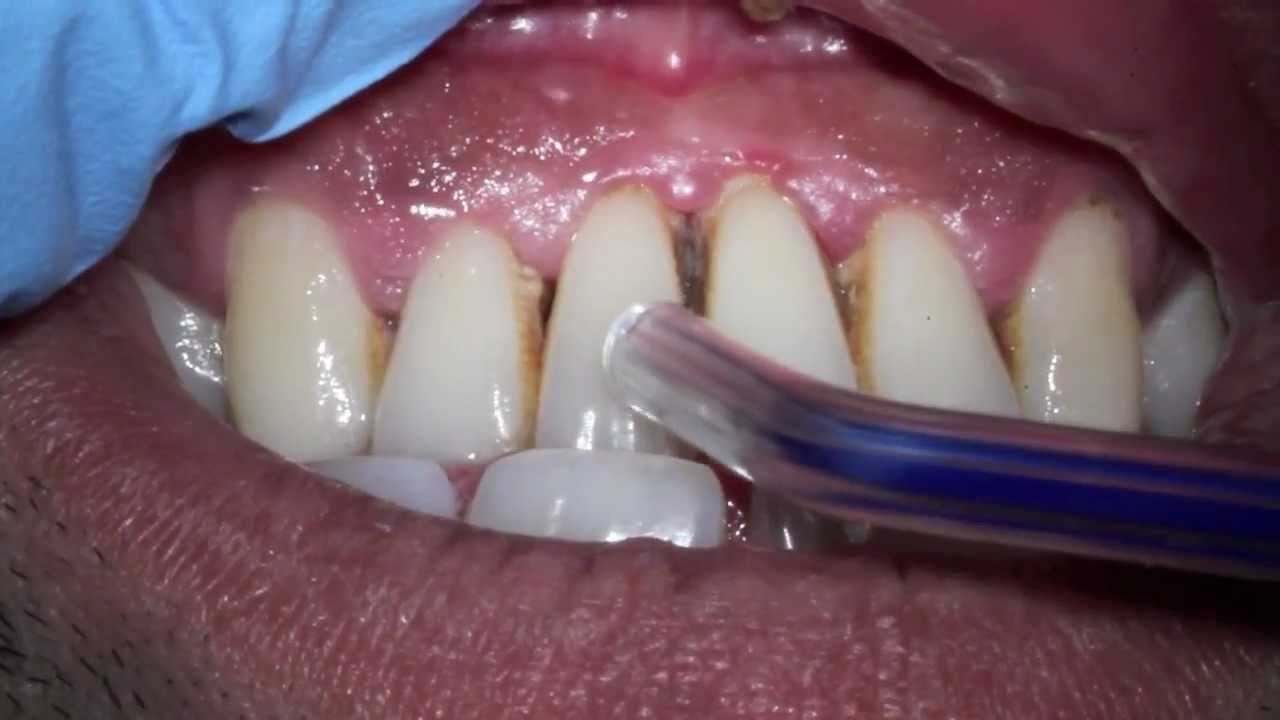 severe-gum-disease-advance-periodontitis-with-smoking-stain-and-pus