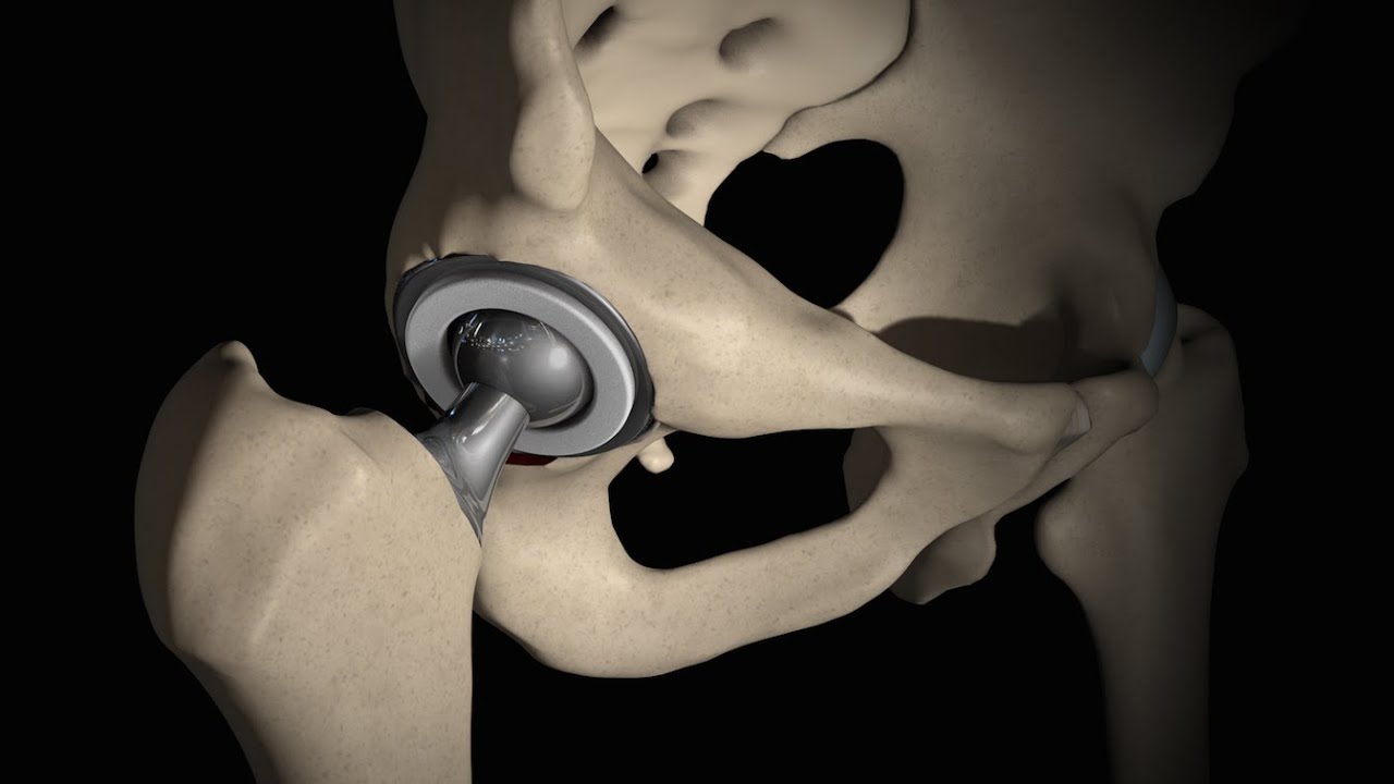 Direct Anterior Approach Hip Replacement YouTube