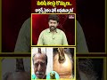 మనిషి తలపై కొమ్ములు.. డాక్టర్స్ సైతం షాక్ అవుతున్నారు! | Madhya Pradesh | hmtv  - 00:59 min - News - Video
