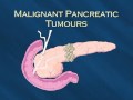 Pancreatic Cancer and the Latest Treatments