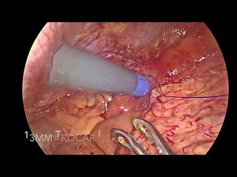 Laparoscopic Trans-Jejunal ERC with Stenting for Recurrent Anastomotic Stricture Following Roux-en-Y Hepatico-Jejunostomy Bypass