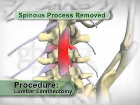 Lumbar Laminectomy Surgery Part 1 YouTube