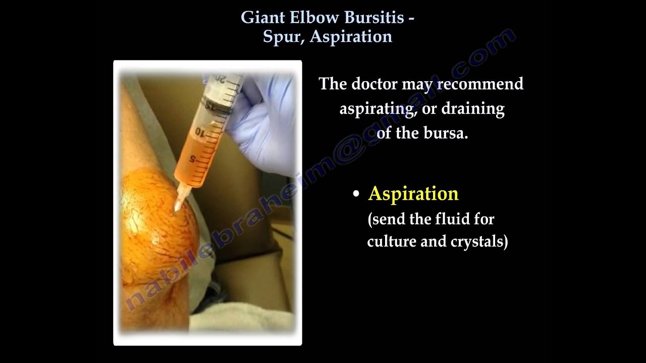 Elbow Bursitis Giant Aspiration Spur Everything You Need To Know Dr Nabil Ebraheim Youtube