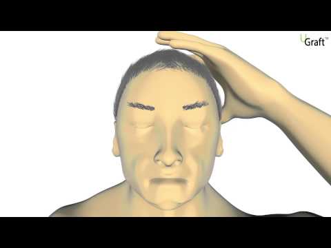 Une animation vidéo de 2014 démontrant comment les fonctionnalités de base du système Dr.UGraft permettent d’extraire avec succès différents types de follicules pileux du corps et de la tête. Une animation vidéo de 2014 démontrant comment les fonctionnalités de base du système Dr.UGraft permettent d’extraire avec succès différents types de follicules pileux du corps et de la tête.
