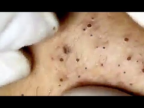 Amazing Blackheads... just wait for it