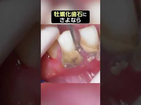 【歯石除去】牡蠣化歯石なんて似合わないわ #歯石除去 #dentist #ザホワイトデンタルクリニック  #歯医者