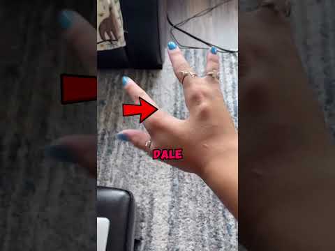 EXTRAÑA ENFERMEDAD EN LOS DEDOS😱