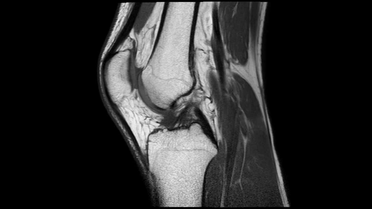 mri-of-a-normal-knee-youtube