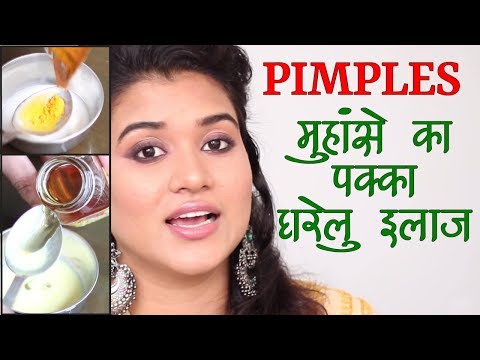 Home Remedies for Pimples / Acne (Hindi)