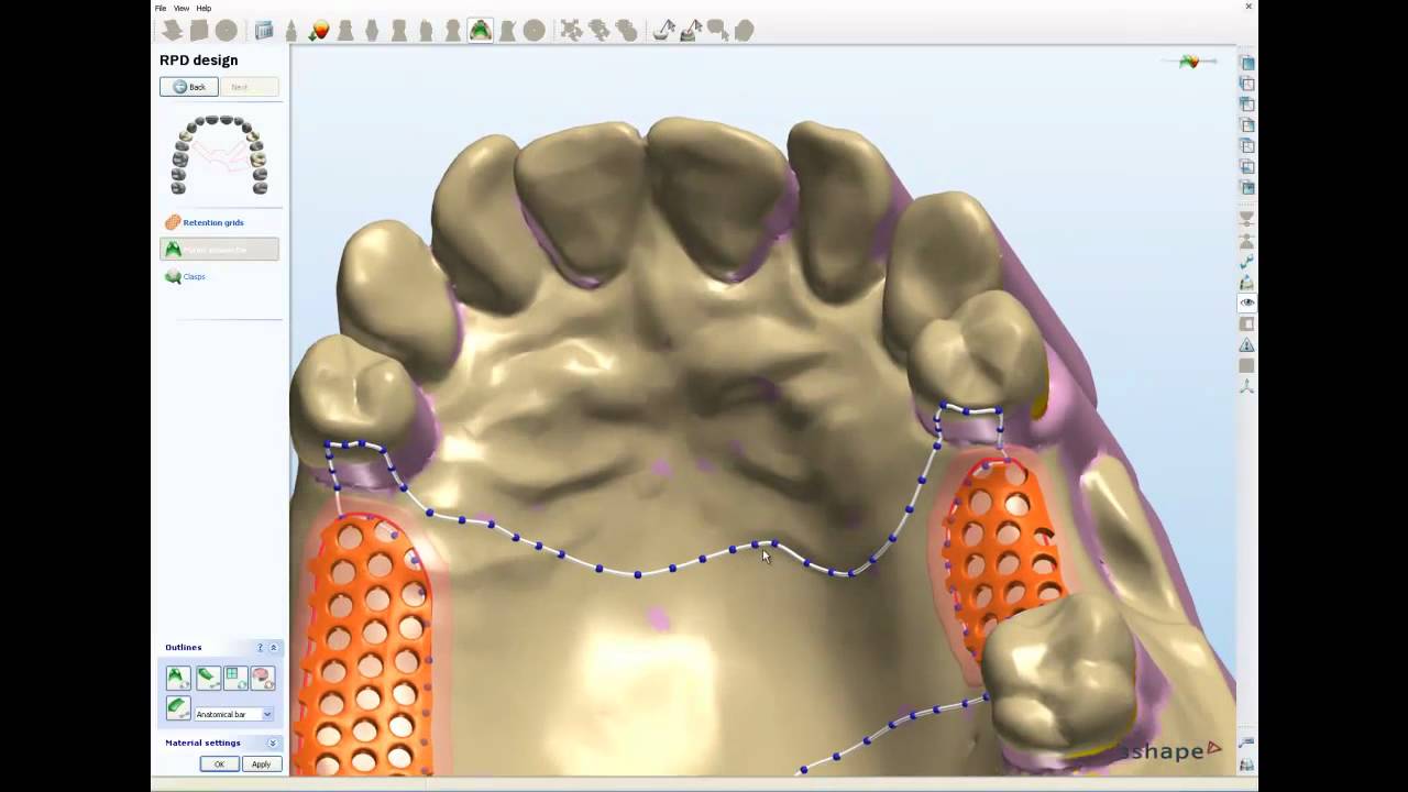 3Shape Removable Partial Framework Design 3 - NEW 2010 - CadBluDental ...