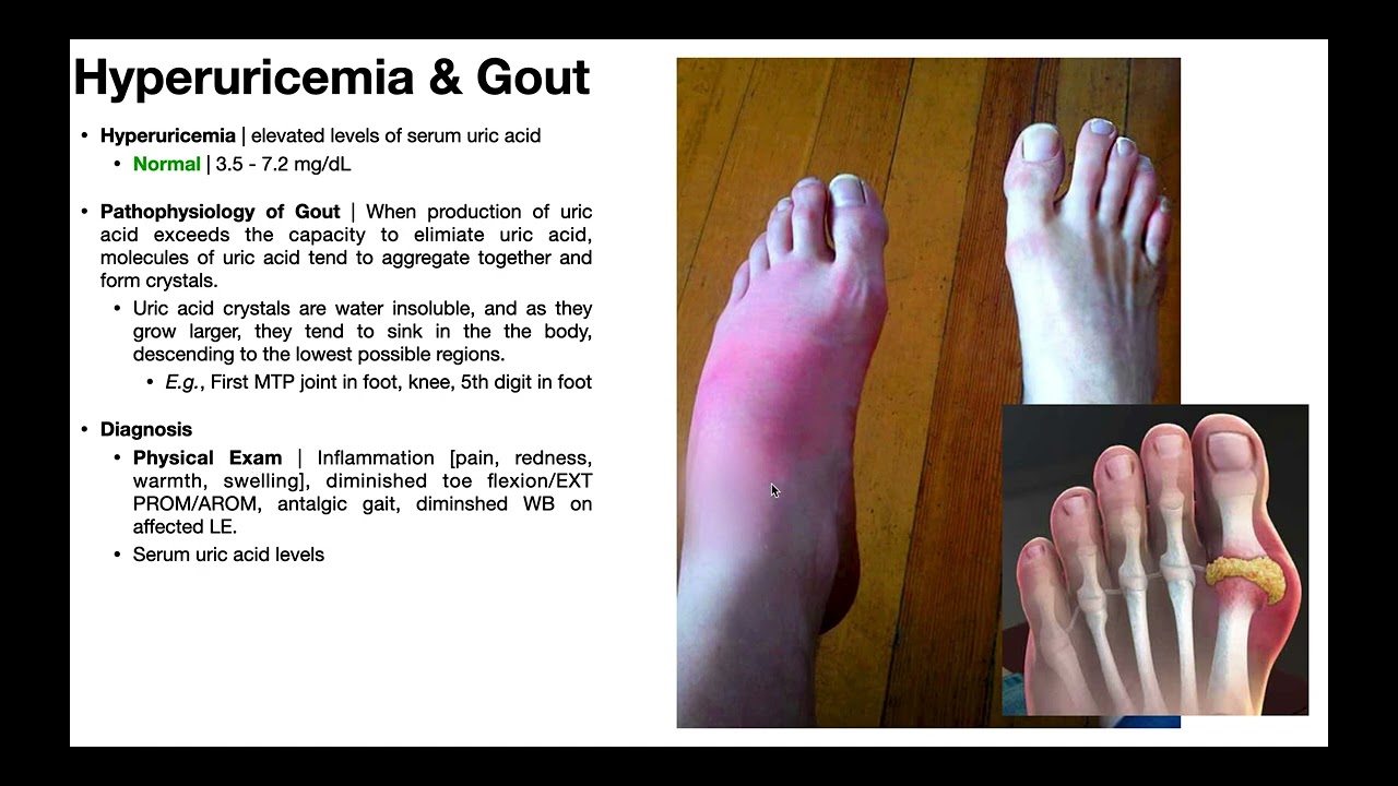 Gout [Part 2] | Gout Pathophysiology, Presentation, & Treatment
